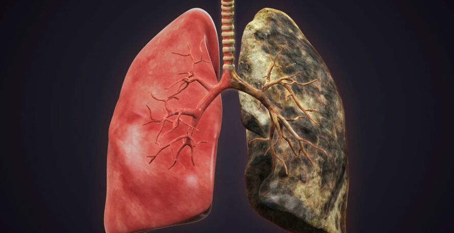 kuřácké plíce a přestat kouřit plíce