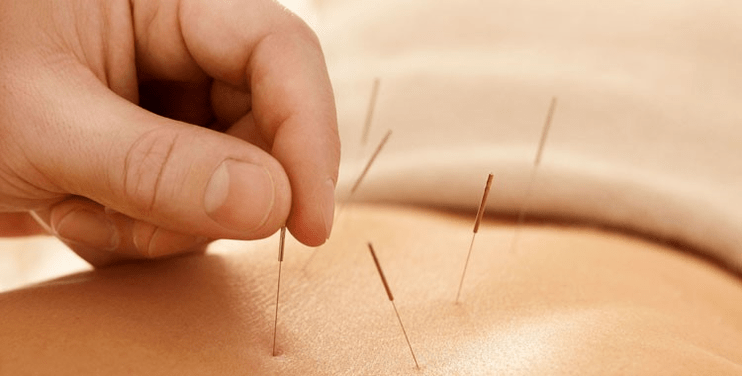 akupunktura proti kouření
